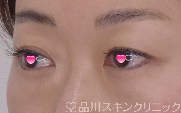 症例NO.65062のBEFORE写真