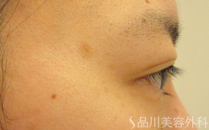 症例NO.71604のBEFORE写真