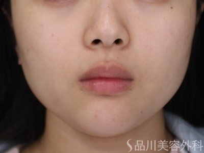 症例NO.73155のBEFORE写真