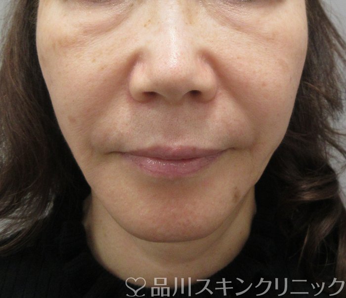症例NO.74389のBEFORE写真