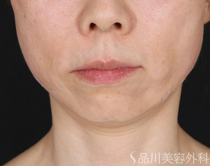 症例NO.71081のAFTER写真