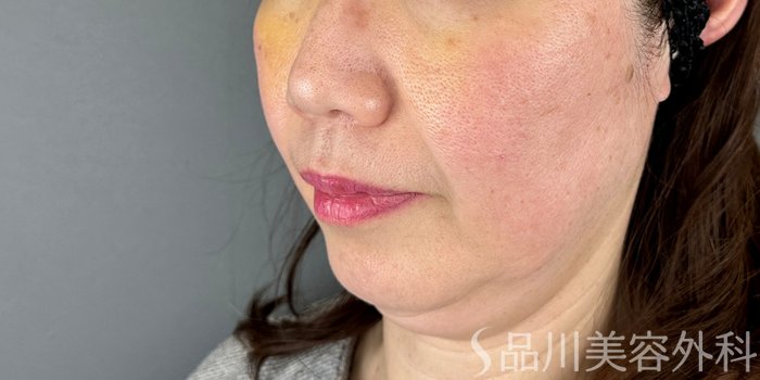 症例NO.67950のBEFORE写真