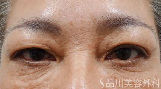 症例NO.69407のBEFORE写真