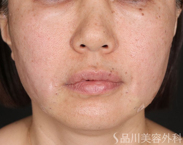 症例NO.73161のAFTER写真