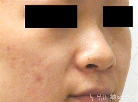 症例NO.49999のBEFORE写真
