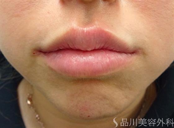 症例NO.34705のAFTER写真
