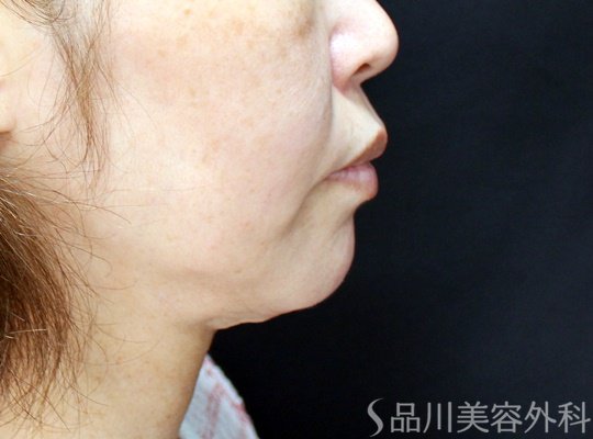 症例NO.70231のBEFORE写真