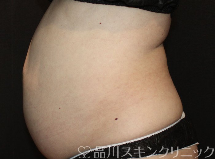 症例NO.73878のBEFORE写真