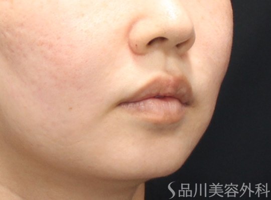 症例NO.75180のAFTER写真