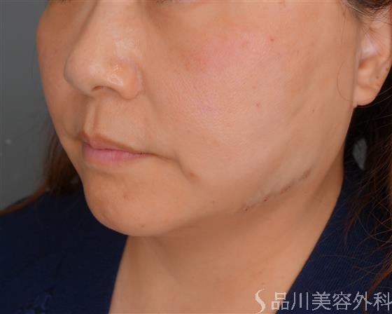 症例NO.53519のAFTER写真