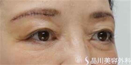 症例NO.35048のAFTER写真