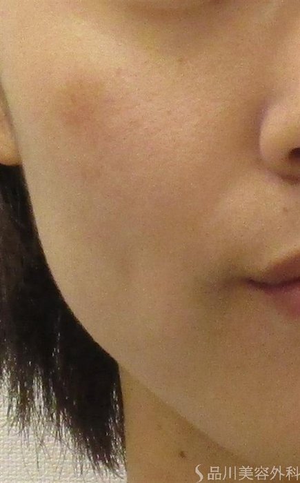 症例NO.56351のAFTER写真