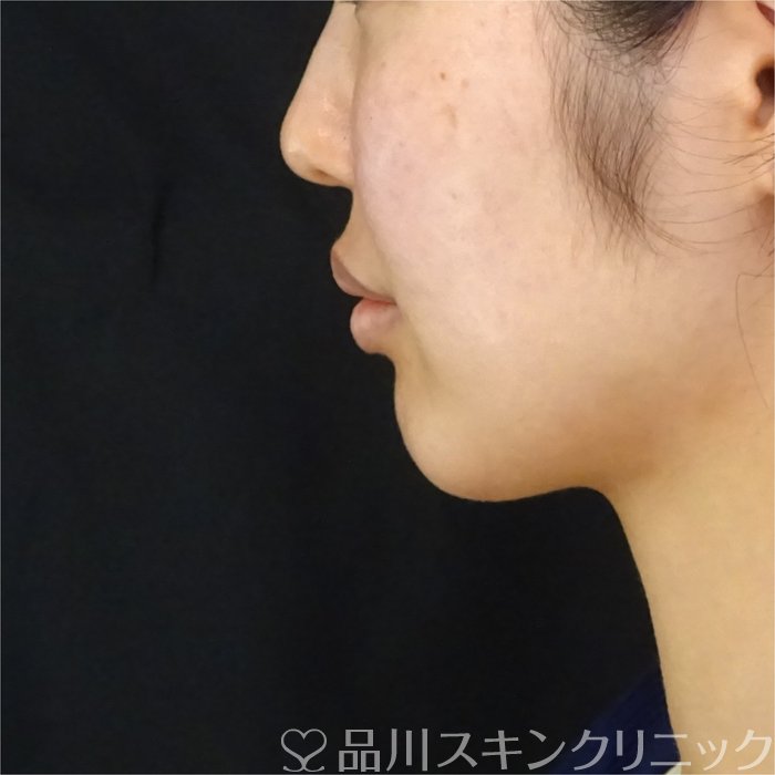 症例NO.71105のAFTER写真