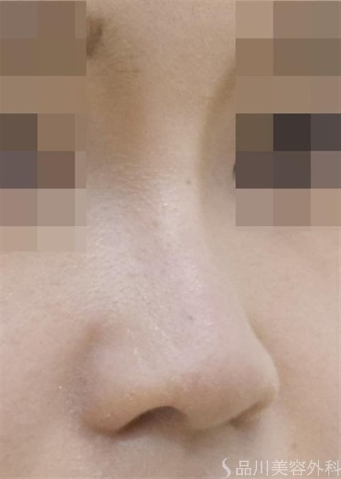症例NO.50691のAFTER写真