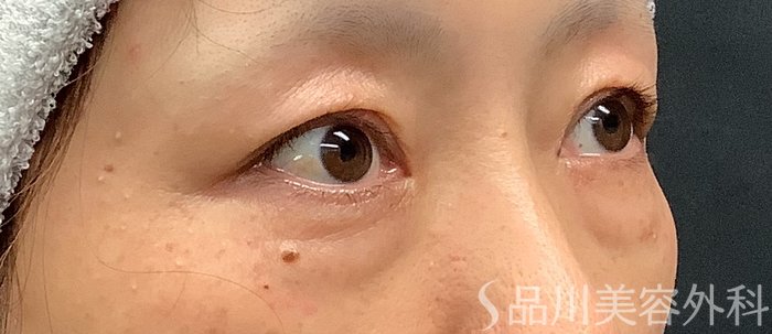症例NO.68966のBEFORE写真
