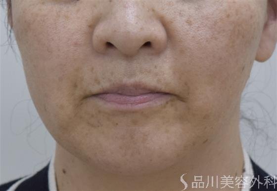 症例NO.48022のAFTER写真