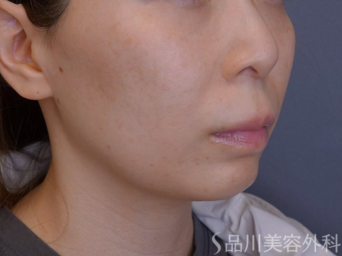 症例NO.74104のBEFORE写真