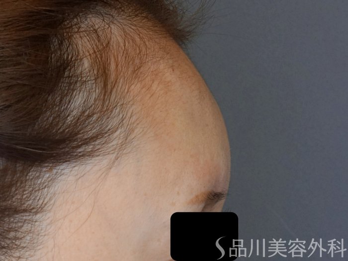 症例NO.72105のAFTER写真