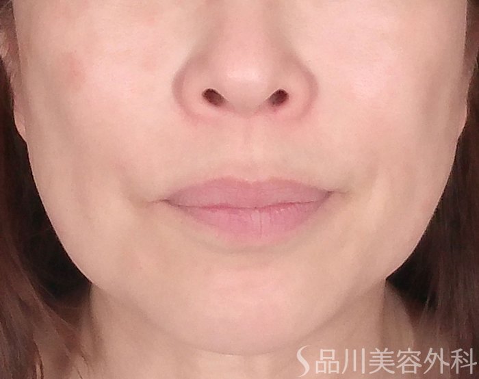 症例NO.70367のBEFORE写真