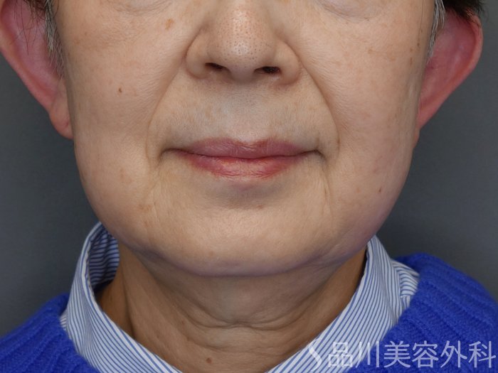 症例NO.72779のBEFORE写真