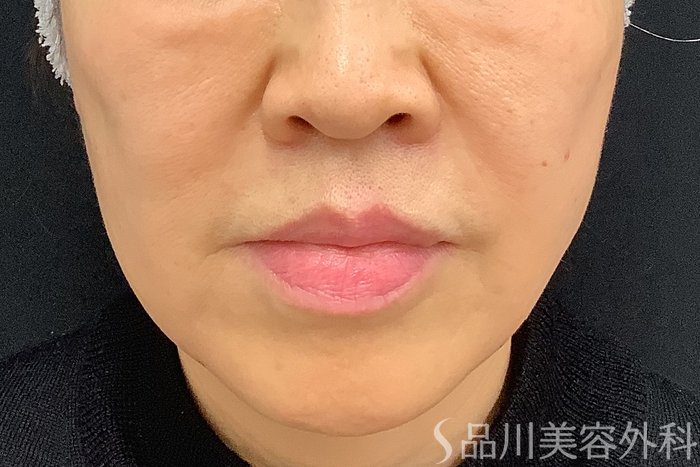 症例NO.73309のAFTER写真