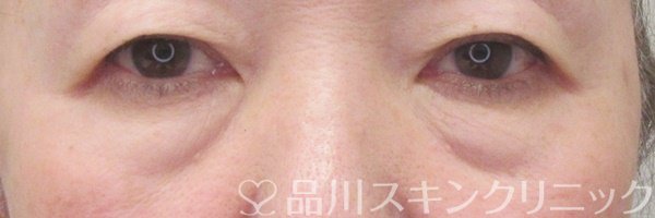 症例NO.71394のBEFORE写真