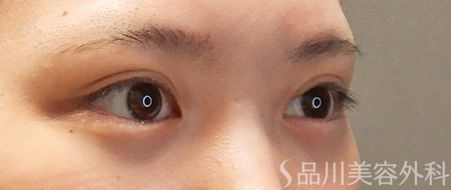 症例NO.71692のAFTER写真