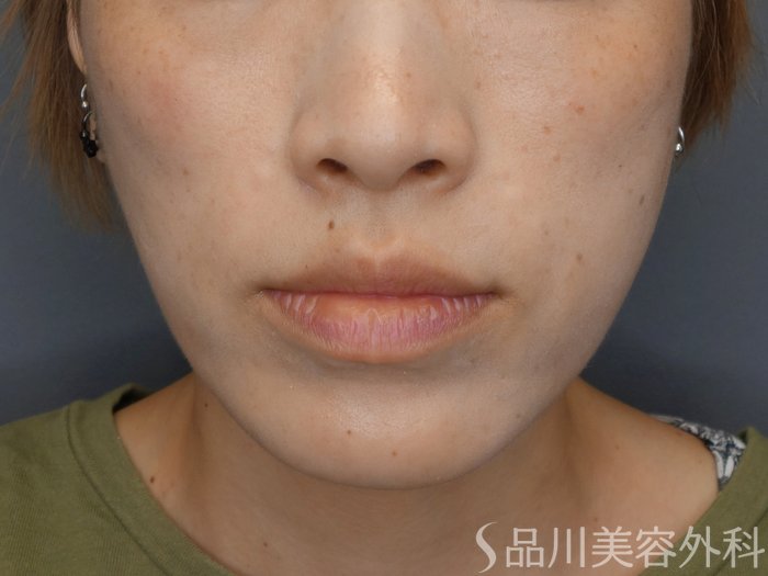 症例NO.71904のAFTER写真