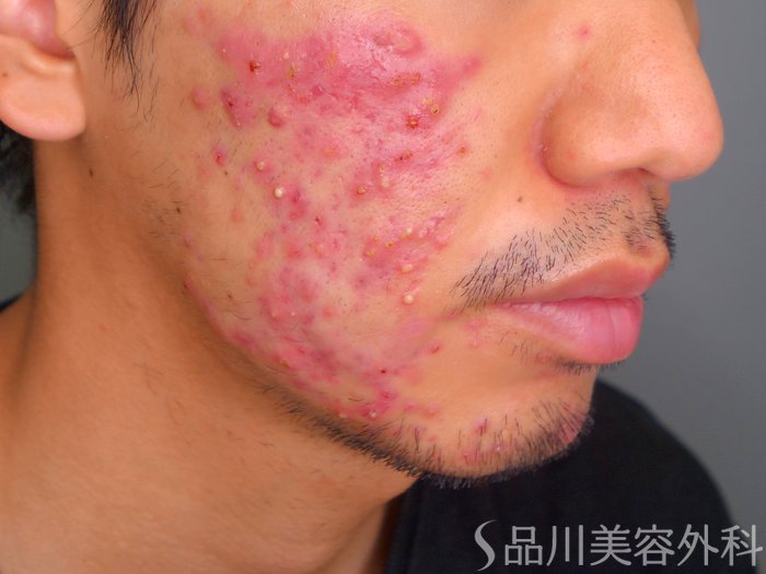 症例NO.68979のBEFORE写真