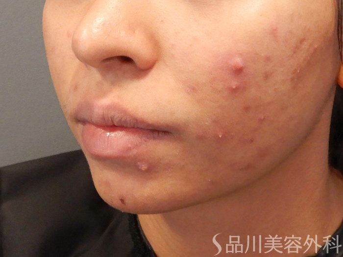 症例NO.70499のBEFORE写真