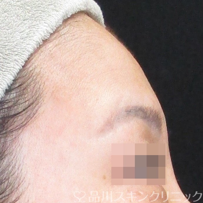 症例NO.74094のBEFORE写真