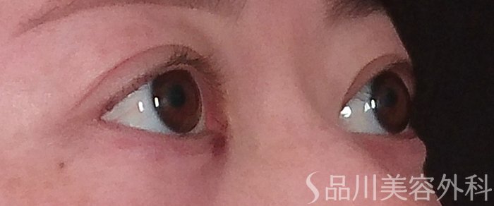 症例NO.69916のAFTER写真