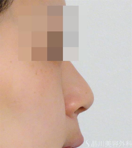症例NO.42639のBEFORE写真