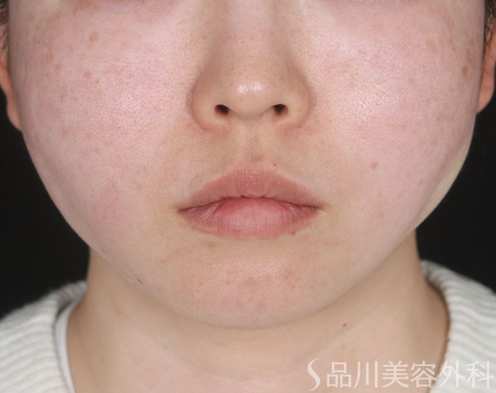 症例NO.73154のAFTER写真