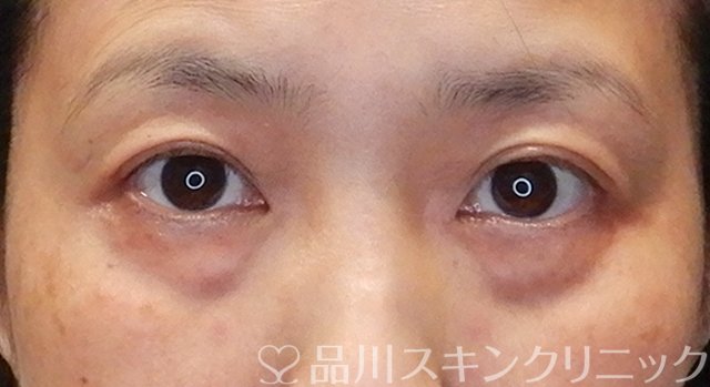 症例NO.75250のBEFORE写真