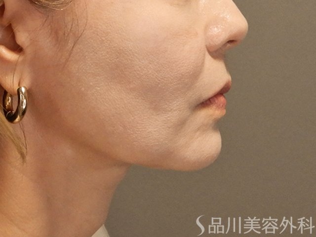 症例NO.71952のAFTER写真