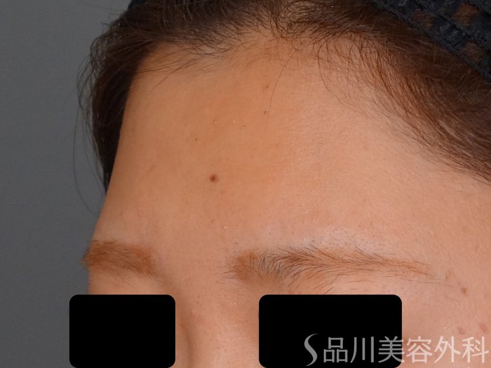 症例NO.68068のBEFORE写真