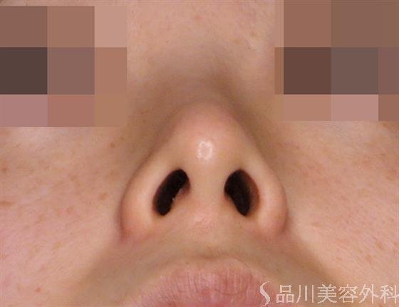 症例NO.47876のAFTER写真