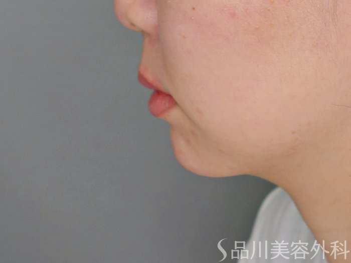 症例NO.70968のAFTER写真