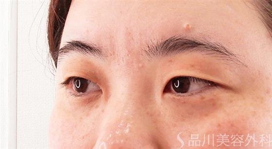 症例NO.61927のBEFORE写真