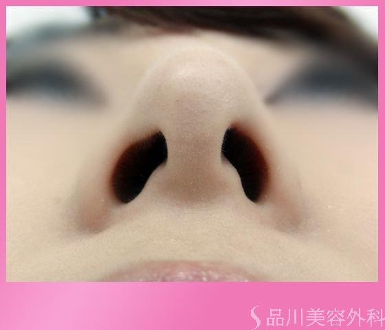 症例NO.1241のAFTER写真