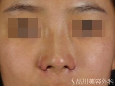 症例NO.72158のAFTER写真