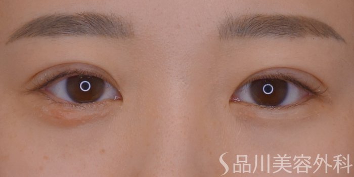 症例NO.73792のAFTER写真