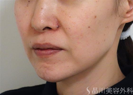 症例NO.40733のBEFORE写真