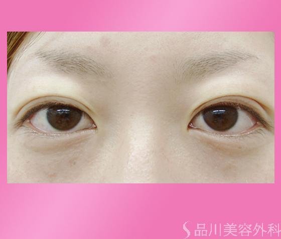 症例NO.862のAFTER写真