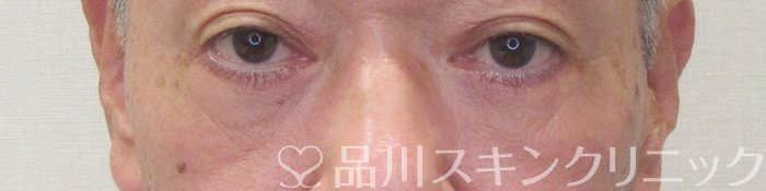 症例NO.70679のAFTER写真
