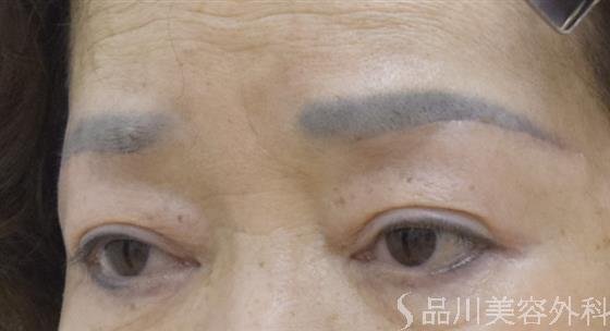 症例NO.54369のAFTER写真