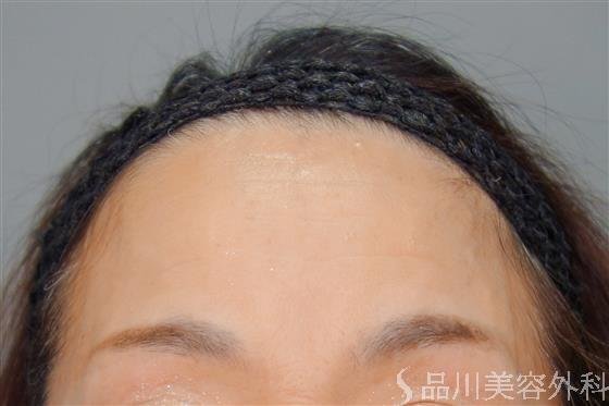 症例NO.54866のBEFORE写真