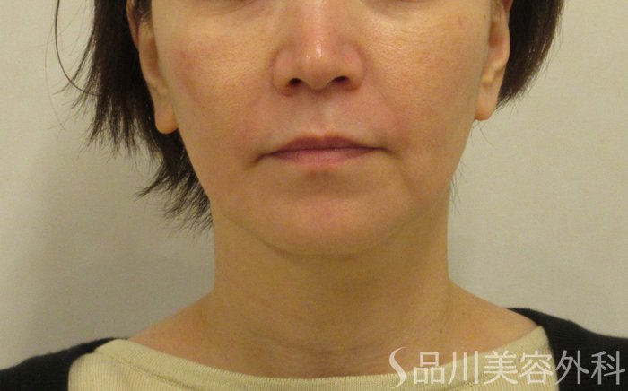 症例NO.72763のBEFORE写真