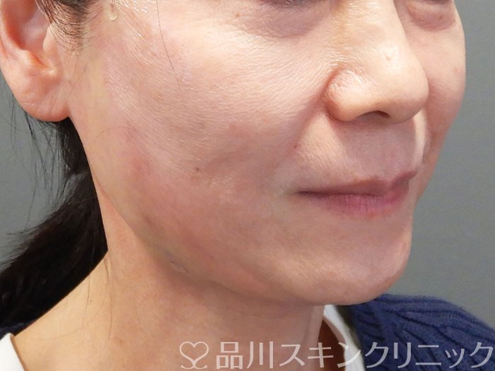 症例NO.73523のAFTER写真